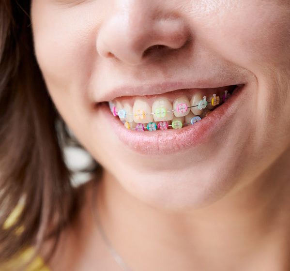 Young woman demonstrating teeth with orthodontic braces. Close up of female patient smiling and showing brackets with multicolored rubber bands. Woman demonstrating wired braces with colorful dental rings. Concept of dentistry, orthodontics and stomatology.