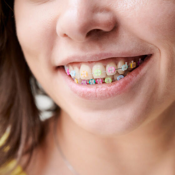 Close up of female patient smiling and showing brackets with multicolored rubber bands. Woman demonstrating wired braces with colorful dental rings. Concept of dentistry, orthodontics and stomatology.